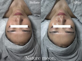 ナチュールムーン(Nature moon.)/ハーブピーリング