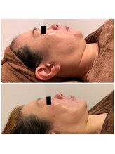 ルノン(LUNON)/艶玉肌へ！小顔フェイシャル