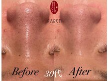 カレン 鹿児島中央駅店/毛穴リメイク