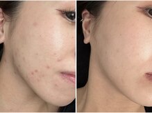 エレマヴィ(ele mavie)/ハーブピーリング/REVI/毛穴ケア