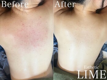 ライム 札幌(LIME)/ハーブピーリング｜背中ニキビ