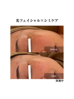 エムドット プラス(M DOT +)/シミケア×最新光フェイシャル
