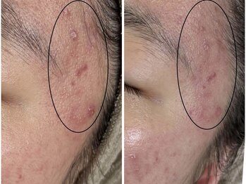 アンリミット 鹿児島天文館店(Une limit)/頑固な肌荒れに