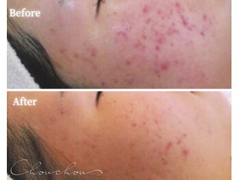 シュシュ(Chou chou)/【Before★After】ニキビ改善