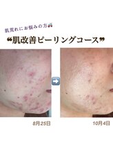 アイリス(AIRIS)/フェイシャル/毛穴洗浄/美白