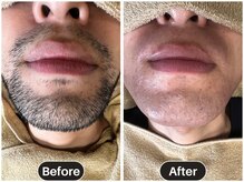 エスポワール(Espoir)/グッバイ青ひげ！ダブル脱毛