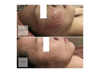 ベルティーク(BELTHEQUE)/ニキビケア