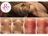 【毛穴開き撃退】REVIハーブピーリング＋生酵素パワーで肌汚れ除去オプション