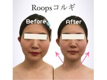 ループス(Roops)/ビフォーアフター【コルギ】