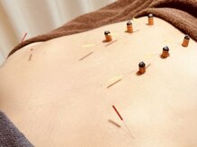 ティルナノーグイリニ(Tir Na Nog-EIRINI)/癒して整える鍼とお灸