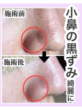 フワリ/黒ずみ毛穴