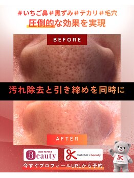 ビューティリュクス(beauty luxe)の写真/長年のいちご鼻・毛穴汚れにサヨナラ！つるつる素肌へ導く集中ケア◎