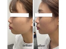 ラムールボーテ(L'AMOUR BEAUTE)/美容鍼