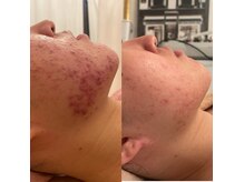 リュクス  Luxe＋tkm 南船場の雰囲気（赤い凹凸ニキビケアには肌の根本肌質改善にハーブピーリング！）