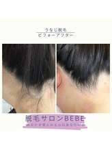ベベ(Bebe)/うなじ脱毛