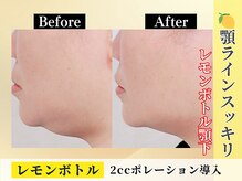 ポーベルポー(Peau Belle poe)の雰囲気（話題の脂肪分解【レモンボトル】導入！ここ痩せが叶う小顔矯正◎）