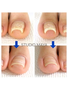 スタジオ マヤ(STUDIO MAYA)/巻き爪ケア/BSブレイス