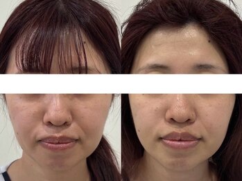 サクラ 本厚木駅前店(SAKURA)/ハーブピーリング