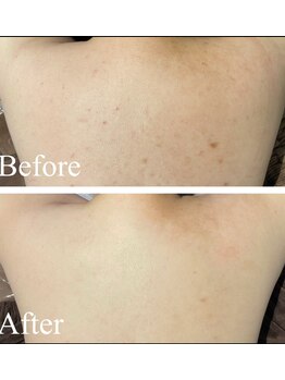 エミルカ 新宿(EMILUCA)/シミこそハーブピーリング