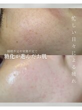 カムイ/ハーブピーリング2回剥離あり