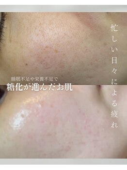 カムイ/ハーブピーリング2回剥離あり