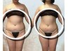 【人気】痩身60分/腹&背中orお尻～足首/キャビor吸い上げ＆ラジオ波（通常）