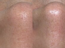 アイグラッド 新宿御苑前店(eyeglad)/毛穴洗浄＋艶肌Wax 新宿