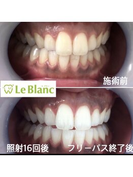ルブラン 奈良店(Le Blanc)/16回照射で白い歯に!!