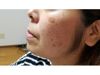 プラーベートサロン エクラ(eclat)/ハーブピーリング