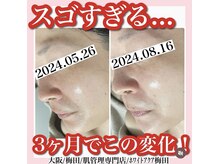 ホワイトアクア 梅田本店(WHITE AQUA)/ララピール/大阪/梅田/毛穴/小顔