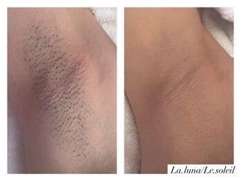 ラ ルーナ ル ソレイユ(La.luna Le.soleil)/レディースパーツ脱毛