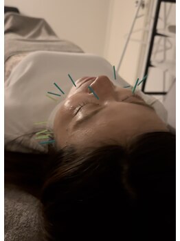 ラフテル鍼灸整骨院/美容鍼でフェイスラインスッキリ