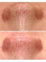 ミリ(MiLi)/毛穴エクストラクション