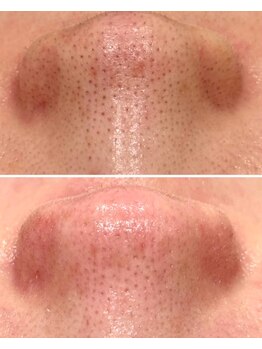 ミリ(MiLi)/毛穴エクストラクション