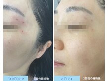 アフロディーテ(APHRODITE)の雰囲気（プラズマ、WIQO水光ピーリング、シミスポットケアでシミが改善）