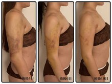 インディバケアプラチナム 麻布十番店の雰囲気（浮腫み・内出血・腫れにインディバは効果大です！！）