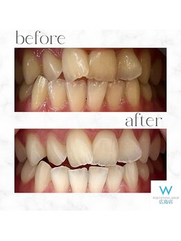 ホワイトニングショップ 広島店(WHITENING SHOP)/【ホワイトニング】Before After