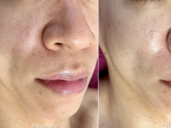 バタフライ 津田沼店(Butterfly)/Butterflyのハーブピーリング