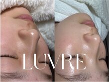 ルーヴレ(LUVRE)/毛穴洗浄