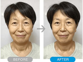 ワト(WATO)/■小顔施術(before→after)
