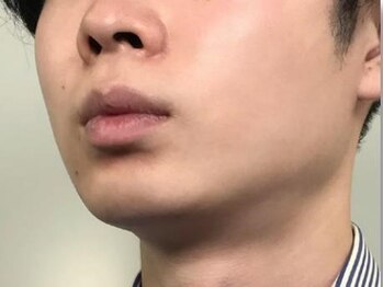 シェリール(CHIRIEUR)の写真/【1周年記念限定★男性全身脱毛10000円】都度払い可◎自分のペースで通える♪肌に優しい脱毛で全身キレイ！