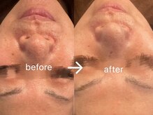 セリーヌ(serene)/ハーブピーリング