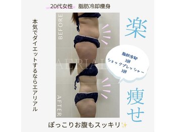 エアリアル 武雄店/脂肪冷却痩身