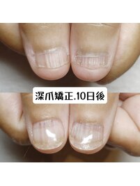 深爪矯正で、ケアもしっかり♪