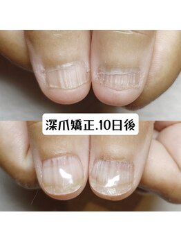 マニエネイル(mani e nail)/深爪矯正で、ケアもしっかり♪