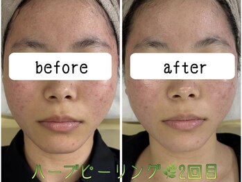 アンリミット 鹿児島天文館店(Une limit)/ハーブピーリング