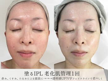 ミヨンラボ(miyon LABO)/塗るIPL老化肌管理1回