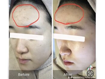 モカ 天王寺店(MOKA)/おでこニキビケア　毛穴