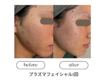 なごみの雰囲気（【最新美容】プラズマフェイシャル）