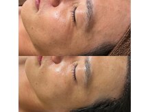 ヨルエステ(yoru aesthe)の雰囲気(その日焼け、将来のシミ・老け見えに。今から始める大人の肌投資)